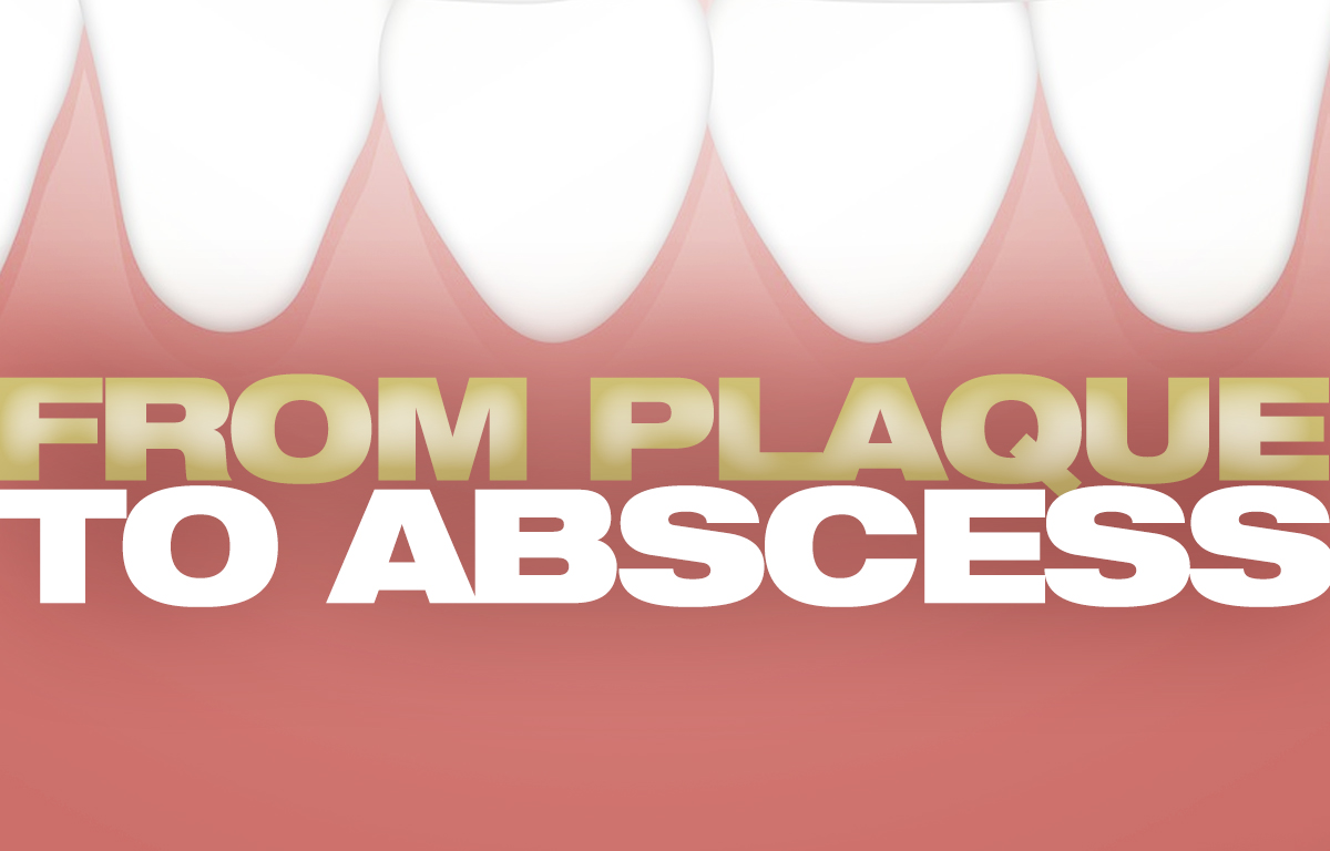 Plaque to abscess