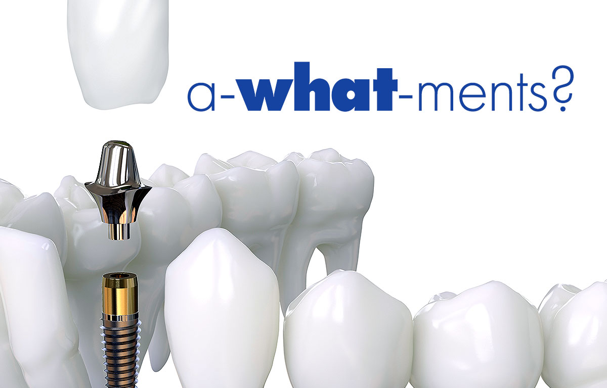 What Are Dental Implant Abutment?
